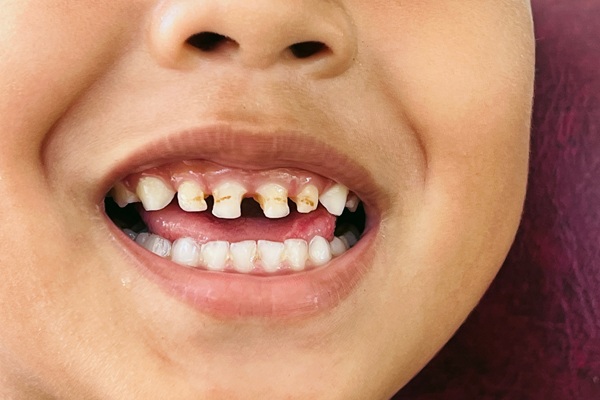 Cavity Treatment For Kids: Things Parents Should Know