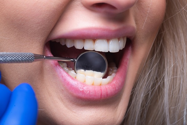 Frequently Asked Questions About Dental Fillings